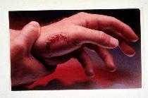 hand bitten by dog