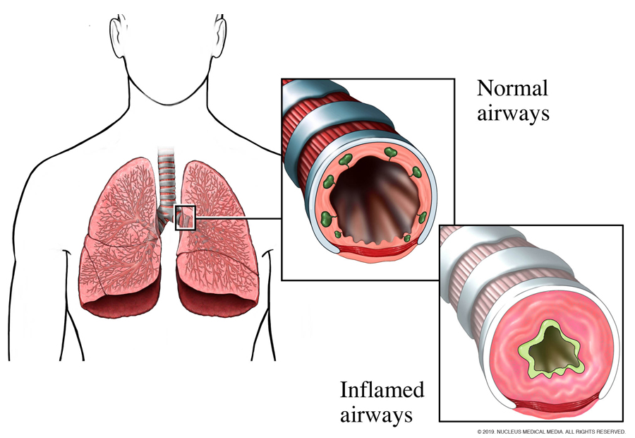 graphic of a helathy airway and an inflamed airway. 
