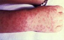 Rash from Rocky Mountain Spotted Fever