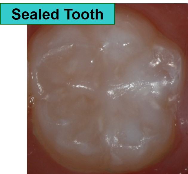 Sealed tooth