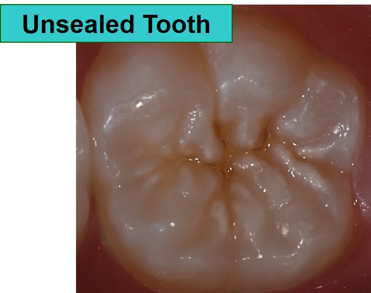 Unsealed tooth