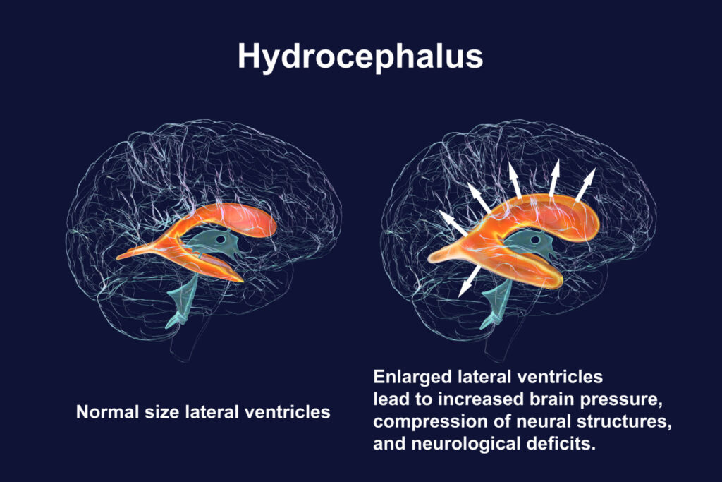 Illustration of enlarged and normal ventricles in the brain