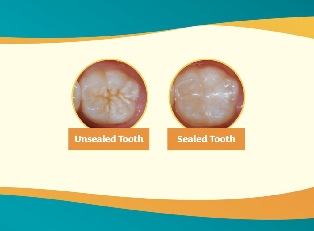 Dental Sealant before and after