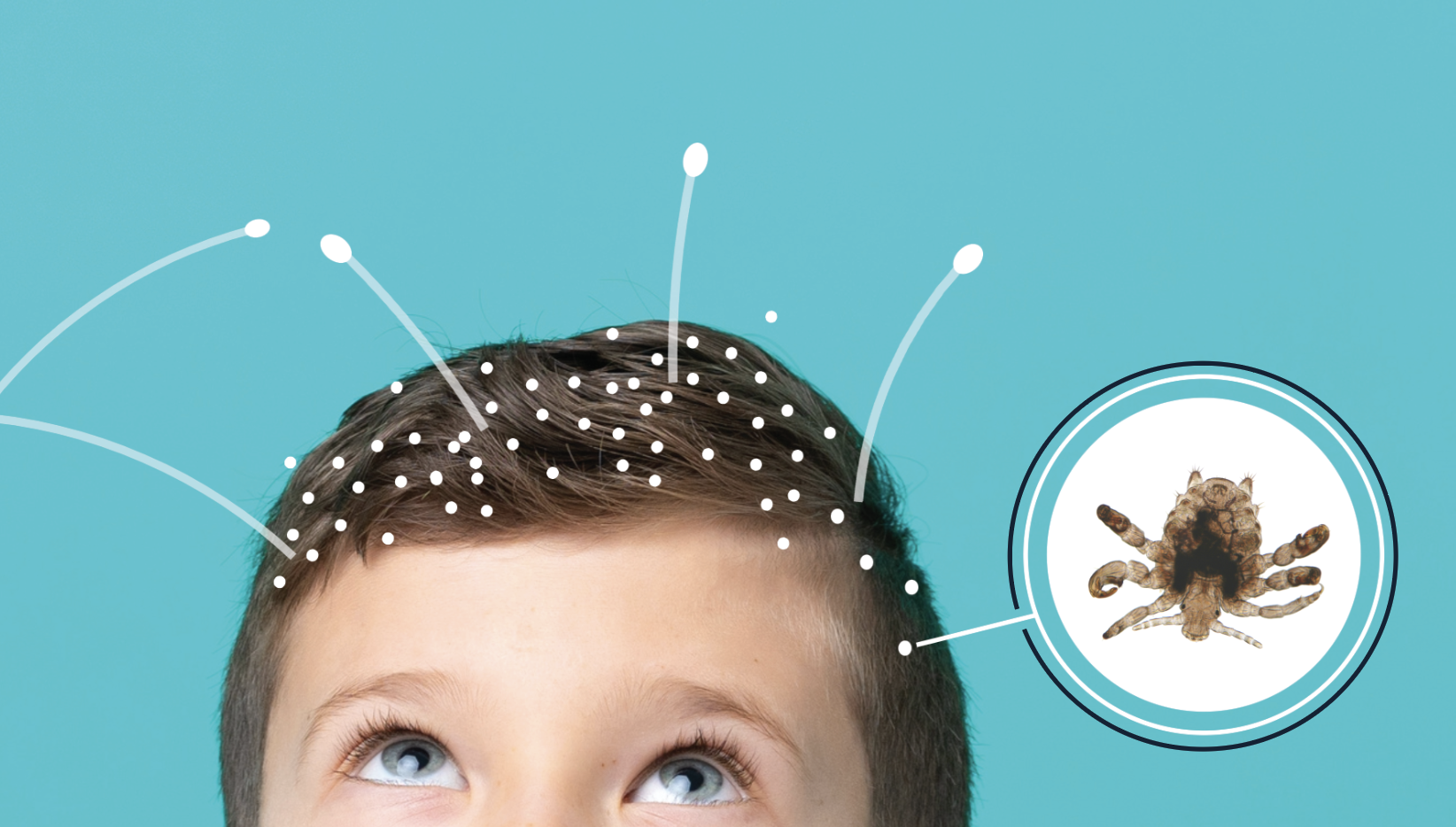 Close-up of a child's head with dark hair covered in white dots representing lice
