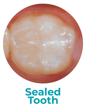 Close-up of a molar tooth that has a sealant applied