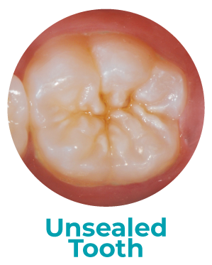 Close-up of a molar tooth that has no sealant applied